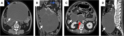 Case report and literature review: Giant retroperitoneal cystic lymphangioma